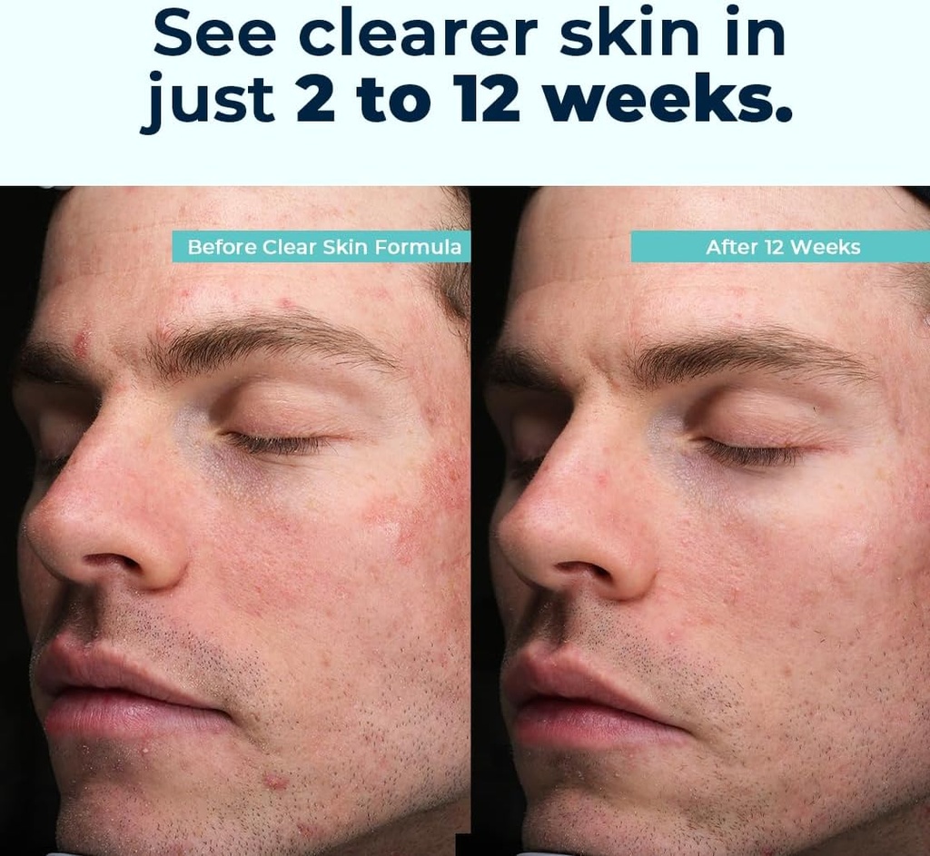 VitaMedica Clear Skin Vitamin Formula | Noncystic Acne Supplement for Skin Clearing | Breakout Treatment for Women and Men | Vitamins A, C, E, Selenium, Chromium, and Zinc for Skin Health | 2 Pack 4