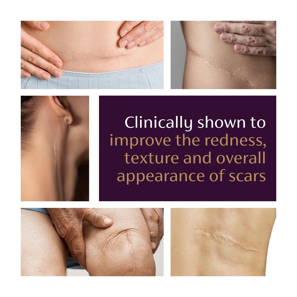 mederma-advanced-scar-gel-treats-old-new-5.jpg