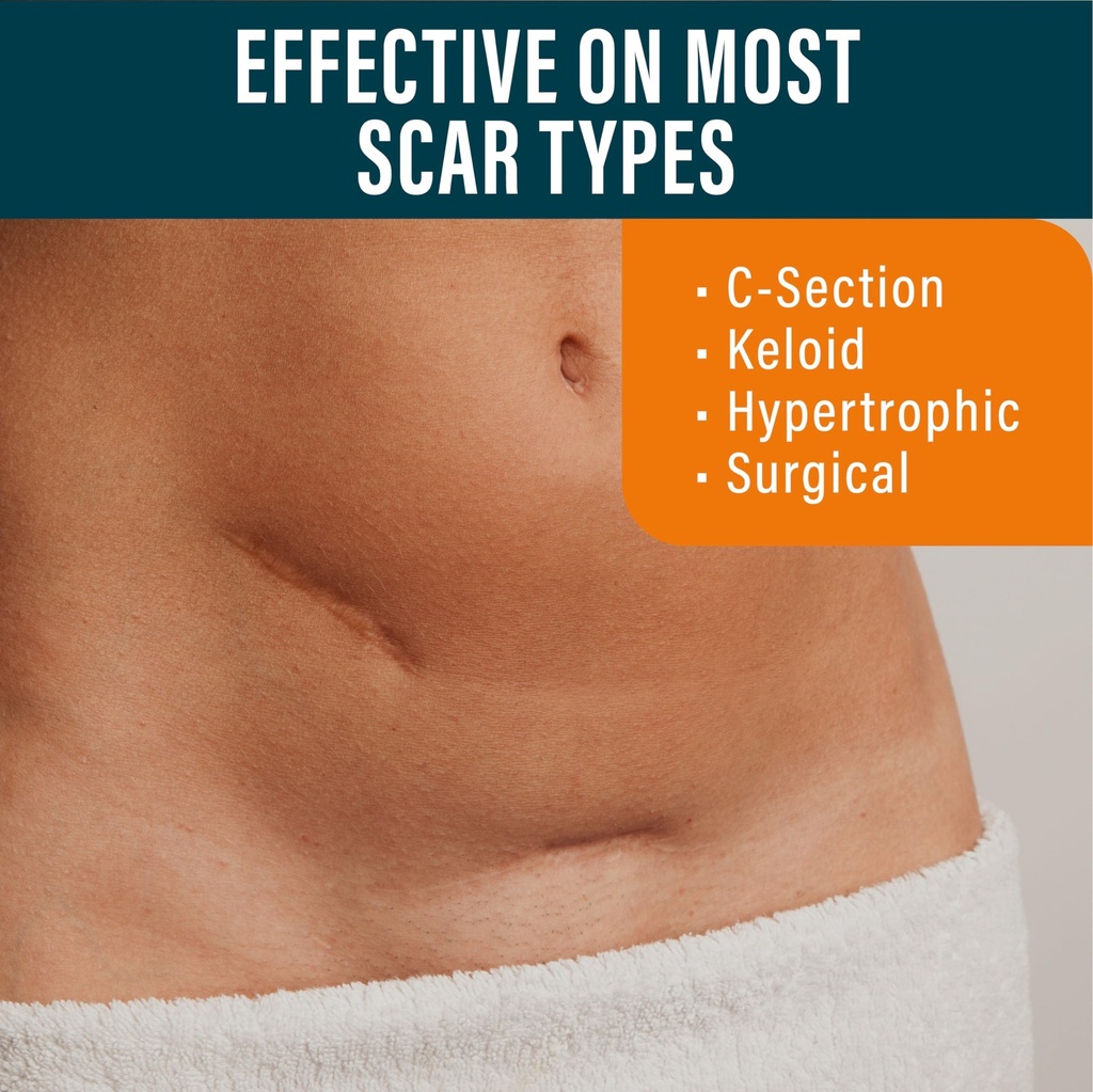 nuvadermis-silicone-scar-sheets-extra-lo-4.jpg