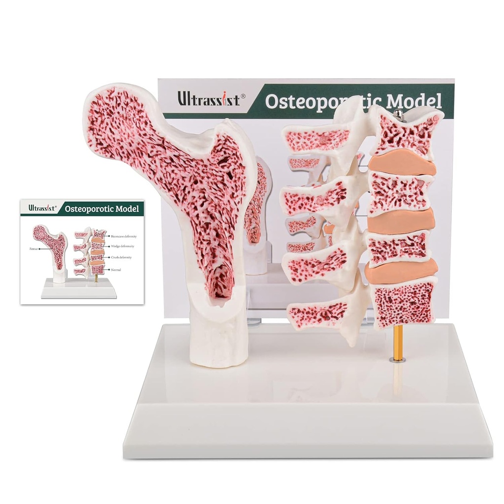 Ultrassist Human Anatomy Osteoporosis Model, Vertebrae Anatomical Skeleton Model with Study Card for Medical Student Teaching Demonstration